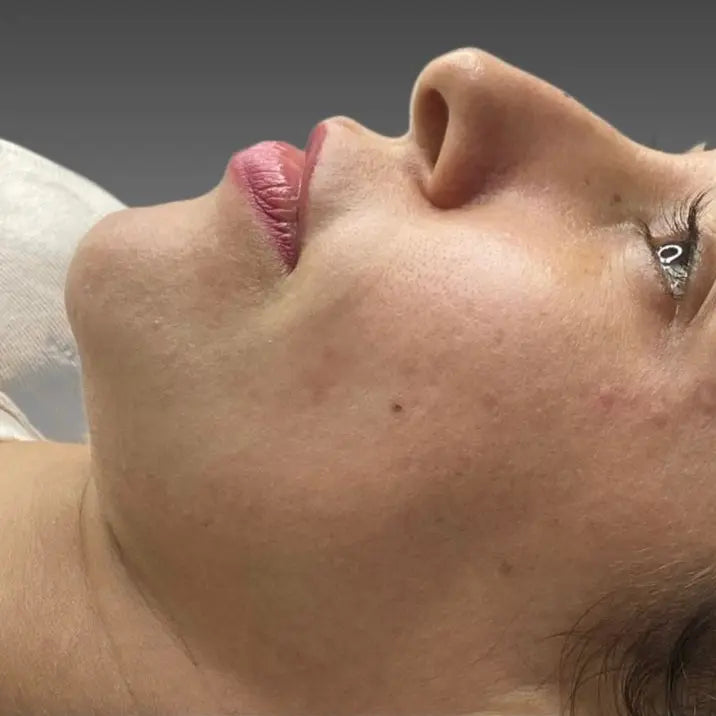 Antes e depois do protocolo Full Face Harmony com rejuvenescimento proporcional